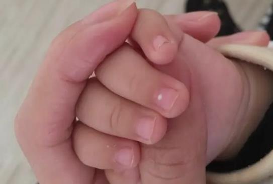 小孩指甲上有白斑怎么办?小孩指甲上有白斑的原因?